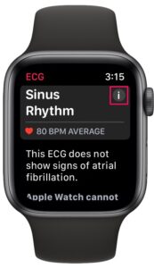 苹果手表心电图应用怎么用，Apple Watch上记录心电图方法